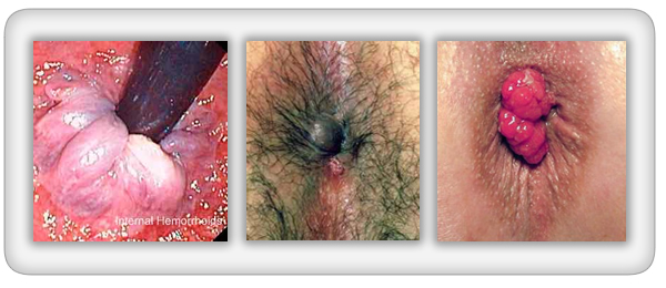 Prolapsed Hemorrhoids Treatment Show effective cure and healing from itching, bleeding and swelling.